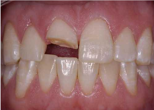 Các loại chấn thương răng cửa có thể gặp Xu-ly-the-nao-khi-rang-bi-chan-thuong