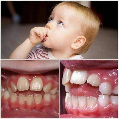 5 “thủ phạm” khiến răng mọc lệch ở trẻ nhỏ