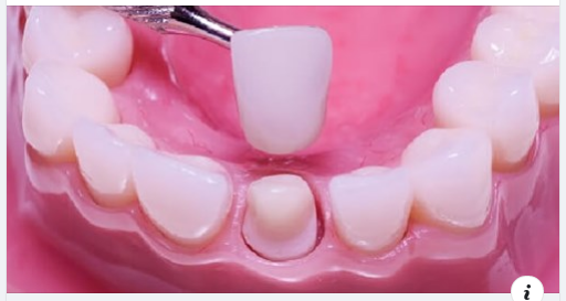 Bọc răng sứ cho răng hô như thế nào ? Quy trình bọc răng sứ cho răng hô tại Art Dentist: