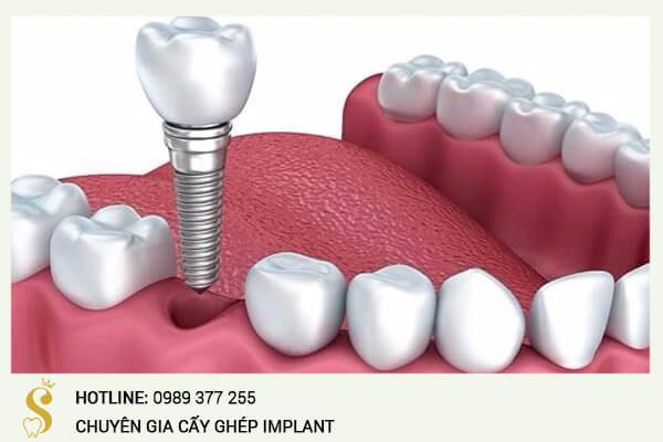 CẤY TRỒNG IMPLANT CHO RĂNG SỐ 6