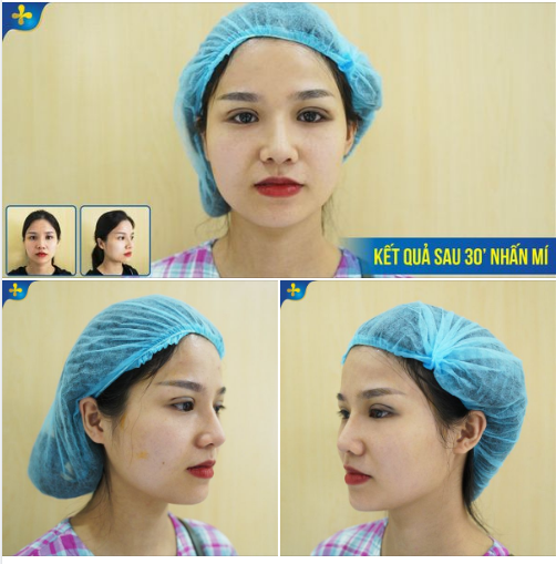 Chiêm ngưỡng kết quả nhấn mí siêu xinh cho nữ khách hàng đến từ Hà Nội ​​​​​​​