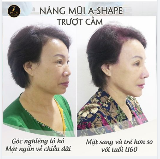 Cô khách U 60 từ Yên Bái đến với Dr Trí để thay đổi diện mạo trẻ trung hơn tuổi với combo nâng mũi A-Shape + tạo hình mí trên và trượt cằm