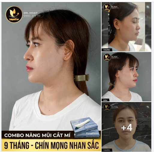 COMBO NÂNG MŨI CẮT MÍ - 9 THÁNG - CHÍN MỌNG NHAN SẮC
