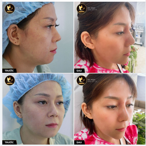 COMBO NÂNG MŨI ĐỘN CẰM 2 NĂM CÓ THAY ĐỔI?