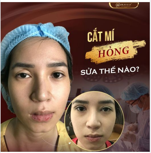 Đã từng có một gương mặt khá ưa nhìn thế nhưng chị khách hàng tại (Sài Gòn) chỉ vì cắt mí thẩm mỹ tại cơ sở thiếu uy tín mà đôi mắt lỗi hỏng