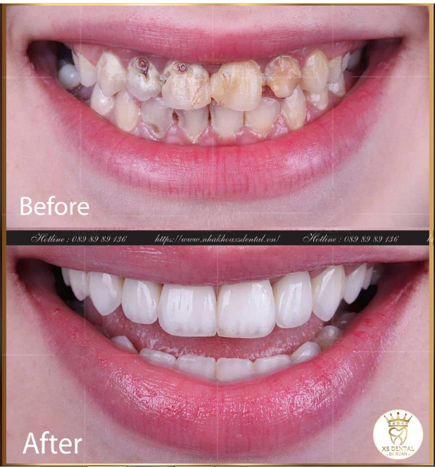 Đầu tuần nha khoa hoàn thành xong ca thẩm mỹ 20 răng sứ Ceramill cho chị khách hàng tới từ thái bình .