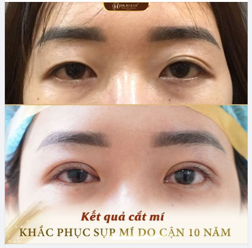 ĐEO KÍNH CẬN BỊ SỤP MÍ CÓ KHẮC PHỤC ĐƯỢC KHÔNG?