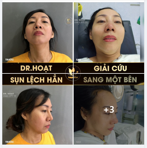 DR.HOẠT GIẢI CỨU - SỤN LỆCH HẲN SANG MỘT BÊN