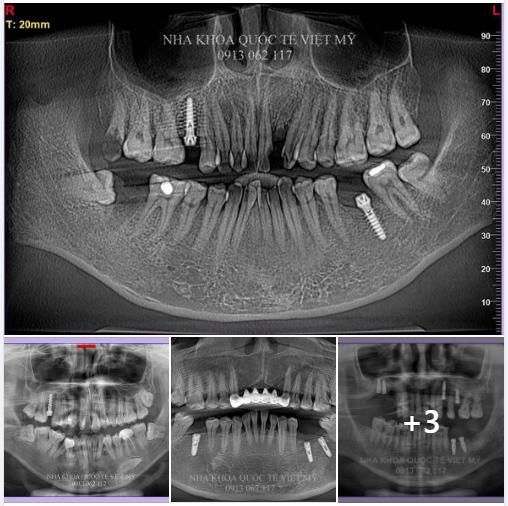 Dưới đây là một số những thước phim chân thực nhất về trồng răng implant tuần vừa qua tại Nha khoa quốc tế Việt Mỹ