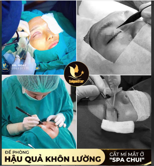 HẬU QUẢ KHÔN LƯỜNG KHI CẮT MÍ MẮT Ở NHỮNG NƠI KÉM CHUYÊN MÔN