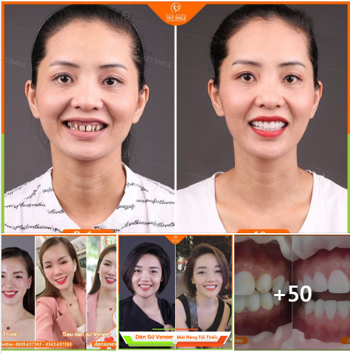 Khách hàng VIET SMILE thay đổi như thế nào sau khi làm răng thẩm mỹ.
