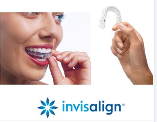 Khi niềng răng Invisalign có ảnh hưởng tới việc phát âm không?