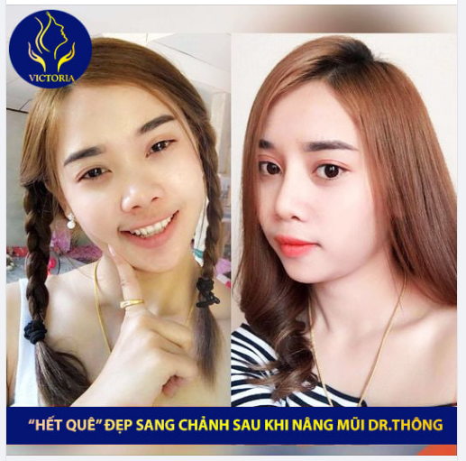 "LÊN ĐỜI" SAU KHI NÂNG MŨI PHONG THỦY TẠI DR.THÔNG