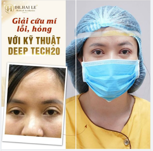 MÍ XẤU HỎNG TỚI ĐÂU - Dr.Hải Lê đều xử lý được với kỹ thuật SỬA MÍ DEEP TECH20.!!