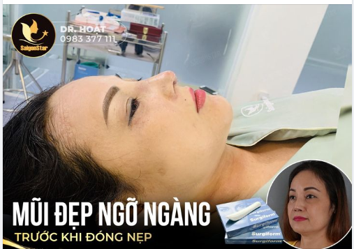 MŨI ĐẸP NGỠ NGÀNG - TRƯỚC KHI ĐÓNG NẸP