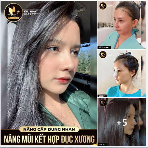 NÂNG CẤP DUNG NHAN - NÂNG MŨI KẾT HỢP ĐỤC XƯƠNG