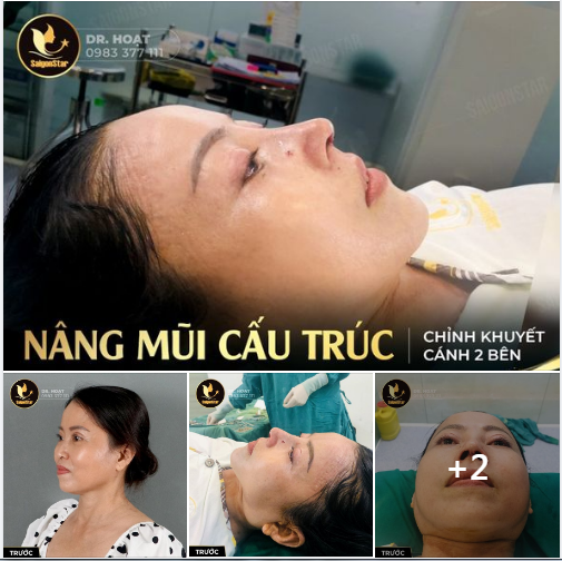 NÂNG MŨI CẤU TRÚC - HỌA LẠI NÉT CUỐN HÚT CHO GƯƠNG MẶT