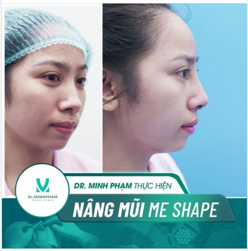 Nâng mũi ME SHAPE- Độc quyền Dr Minh Phạm108: