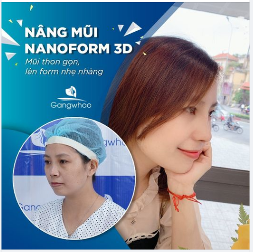 NÂNG MŨI NANOFORM 3D - MŨI THON GỌN, LÊN FORM NHẸ NHÀNG