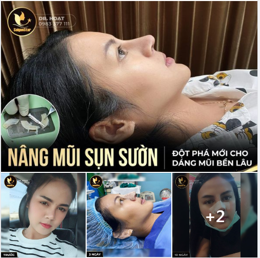 NÂNG MŨI SỤN SƯỜN - ĐỘT PHÁ MỚI CHO DÁNG MŨI BỀN LÂU