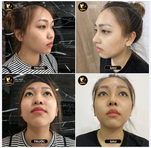 NÂNG NHẸ NHÀNG - THAY ĐỔI NGOẠN MỤC NHỜ NÂNG MŨI CẤU TRÚC VỚI SỤN SURGIFORM