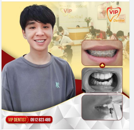 Nguyễn Trần Khải Lâm sau 8 tháng niềng răng tại Vip Dentist 