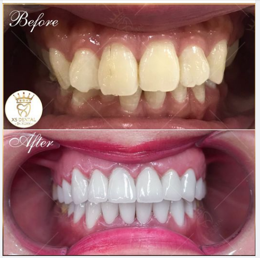 Nha Khoa hoàn thành xong ca thẩm mỹ 19 răng Ceramill cao cấp tại XS Dental .