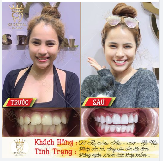 Nha khoa XS dental hoàn thành bộ thẩm mỹ 18 răng sứ cao cấp cho chi khách hàng tới từ Gò Vấp - Sài Gòn .