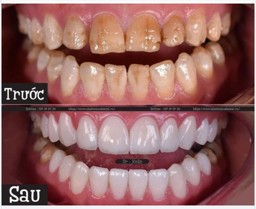Nha khoa Xs Dental hoàn thành xong ca thẩm mỹ 20 răng sứ HT smile .