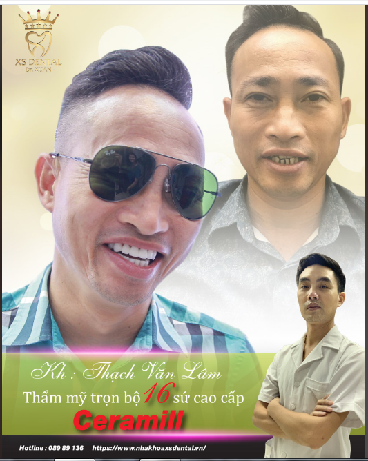 Nha khoa Xs Hoàn thành xong 1 ca thẩm mỹ 16 Răng Cho Anh khách hàng đến từ Long biên - Hà Nội .