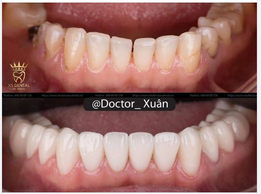 Nha khoa Xs hoàn thành xong ca thẩm mỹ 12 răng hàm dưới cho chị khách hàng tới từ Bắc Ninh .