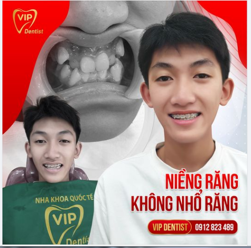 Tấn Phong - chàng trai Yên Bái hóa soái ca với nụ cười mới sau khi niềng răng tại VIP DENTIST!