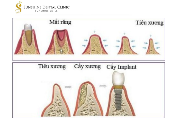 CẤY GHÉP XƯƠNG IMPLANT – GIẢI PHÁP HIỆU QUẢ CHO TIÊU XƯƠNG RĂNG