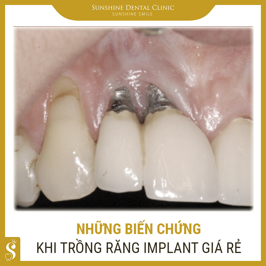 NHỮNG BIẾN CHỨNG KHI TRỒNG RĂNG IMPLANT GIÁ RẺ