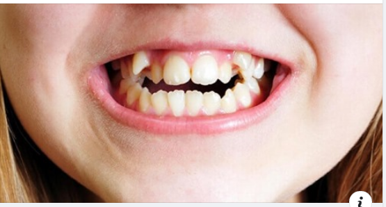 Đối với nhiều người, chiếc răng khểnh chính là điểm nhấn và nét duyên dáng trên khuôn mặt.