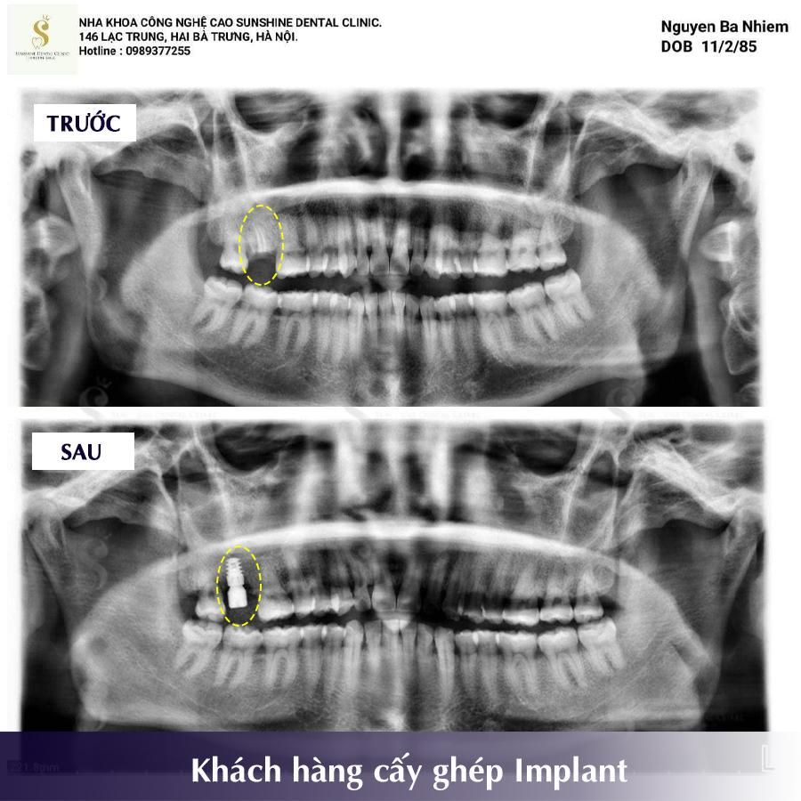 MẤT, GÃY RĂNG SỐ 7 - TRƯỜNG HỢP PHỔ BIẾN Ở NGƯỜI LỚN TUỔI