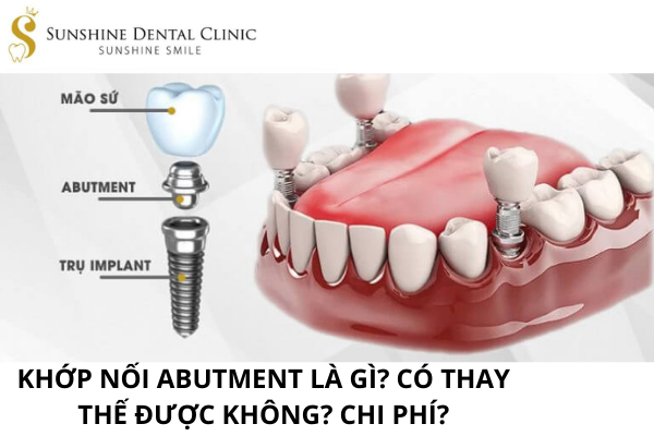 KHỚP NỐI ABUTMENT LÀ GÌ? CÓ THAY THẾ ĐƯỢC KHÔNG? CHÍ PHÍ
