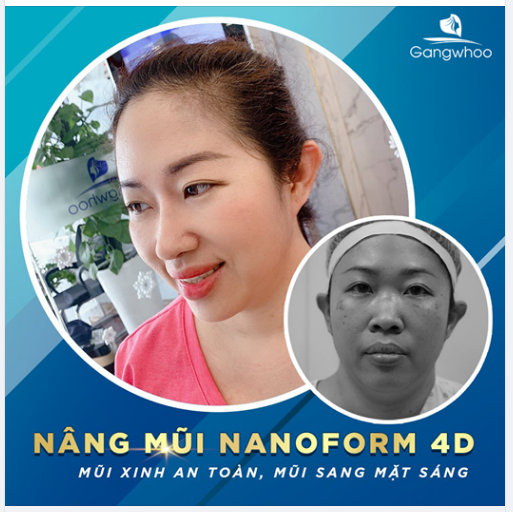 NÂNG MŨI NANOFORM 4D MŨI XINH AN TOÀN, MŨI SANG MẶT SÁNG