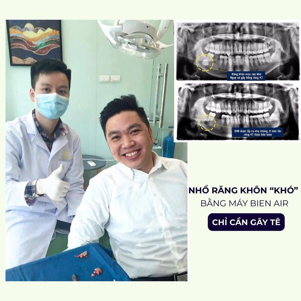 ➡ NHỔ RĂNG KHÔN BẰNG MÁY BIEN AIR
