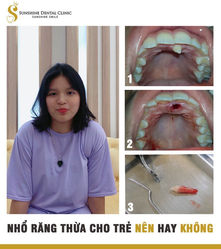 NHỔ RĂNG THỪA CHO TRẺ - NÊN HAY KHÔNG