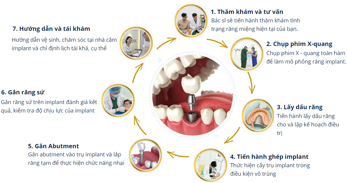 QUY TRÌNH CẤY GHÉP IMPLANT