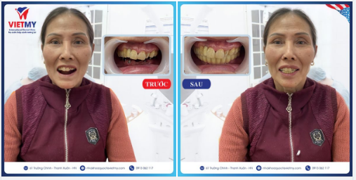 Tiếp tục là 1 ca mất răng của cô Đường Thanh Xuân Hà Nội, hãy cùng xem những chia sẻ của cô về quá trình làm lại hàm răng tại nha khoa nhé