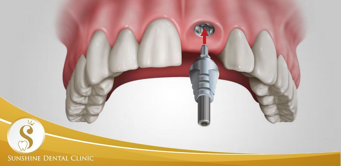 TRỒNG IMPLANT TRONG VÙNG THẨM MỸ, NHỮNG KIẾN THỨC KHÔNG THỂ THIẾU