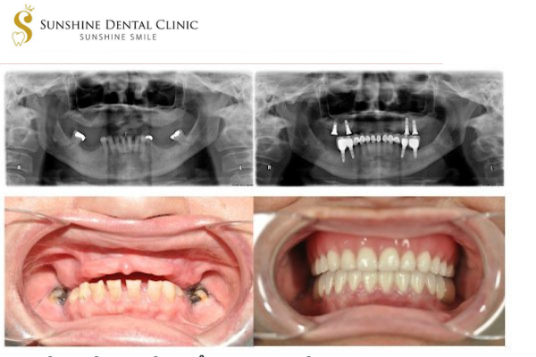 CẤY GHÉP IMPLANT TỨC THÌ RÚT NGẮN THỜI GIAN – TĂNG TÍNH AN TOÀN