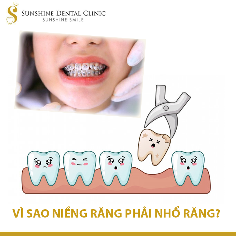 ?? VÌ SAO NIỀNG RĂNG PHẢI NHỔ RĂNG?
