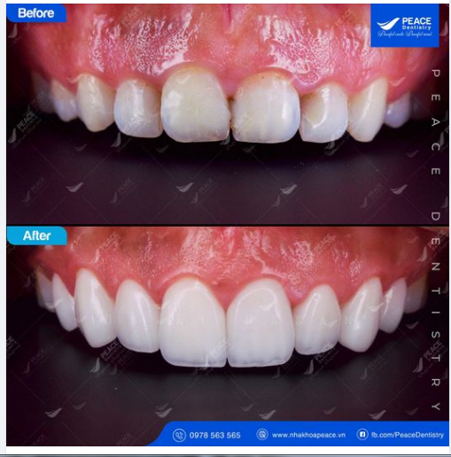 Ca lâm sàng: Mặt dán sứ Veneer siêu mỏng Emax Multy với tỷ trọng mà răng cực thấp