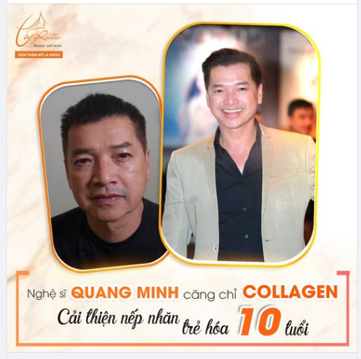 CĂNG CHỈ COLLAGEN CẢI THIỆN NẾP NHĂN Cùng diễn viên Quang Minh TRẺ RA 10 TUỔI