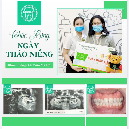 CHÚC MỪNG NGÀY THÁO NIỀNG Nha Khoa Đăng Lưu chúc mừng bạn Lê Trần Mỹ Hà đã niềng răng thành công!