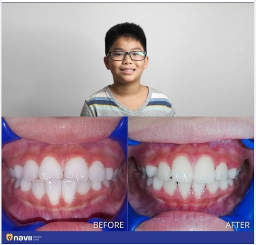 CÓ NÊN CHO TRẺ NIỀNG RĂNG SỚM KHÔNG