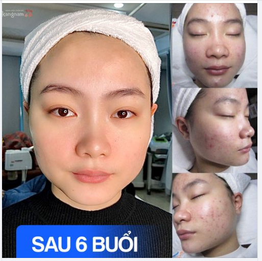 Công nghệ Trị mụn De-acne Sạch mụn viêm sau 6 buổi